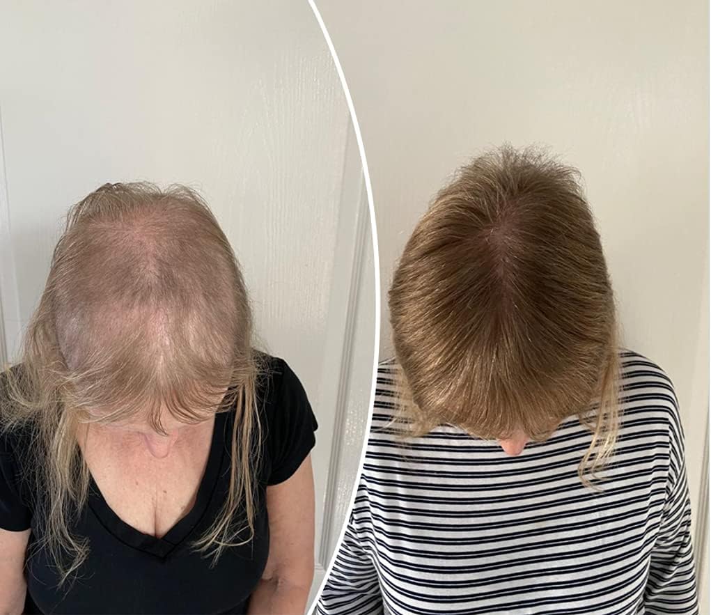 Pharma Hermetic Hair Growth Serum SP55, Professional 7 Week Hair Regrowth Kit, Scalp Serum For Thinning Hair with Biotin, Caffeine and Peptide Complex for Women and Men, Hair Serum (5x5mL)