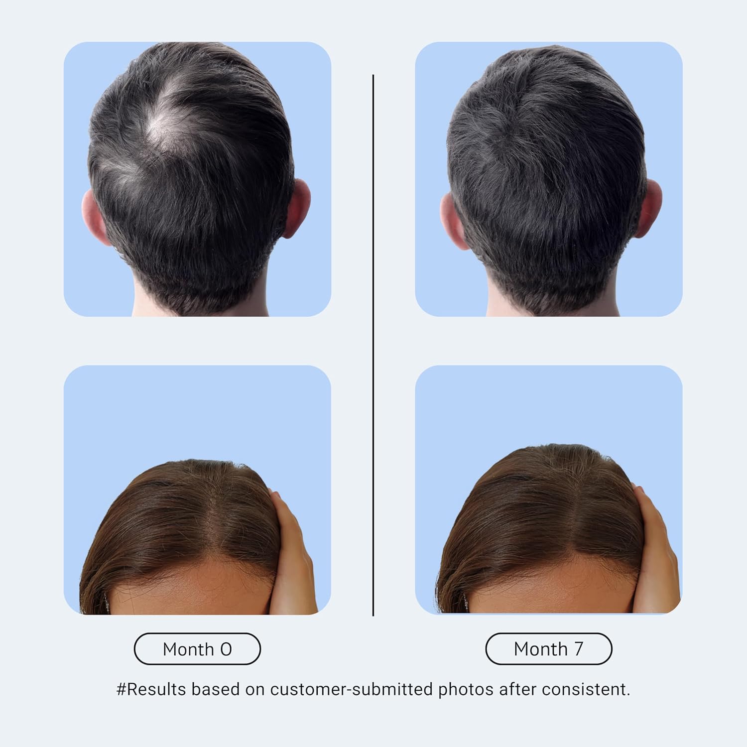 Pro Advanced Hair ReGrowth Supplement 180 Tablets For Women & Men (6 Months Supply - 6Pack x 30Tab)